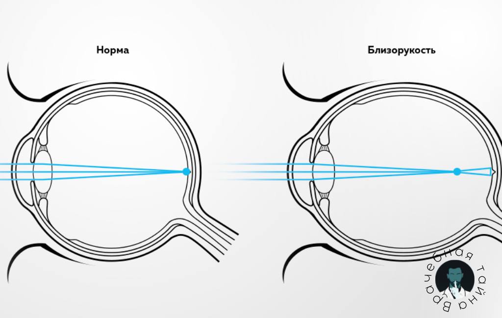 Фокусировка глаза человека. Схема строения глазного яблока при близорукости. Дальнозоркость глазное яблоко удлинённой формы. Миопия гиперметропия астигматизм. Глаз при близорукости и нормальном зрении.