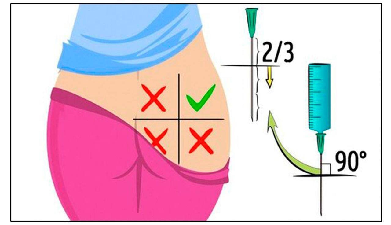Правильно сделать укол в ногу фото