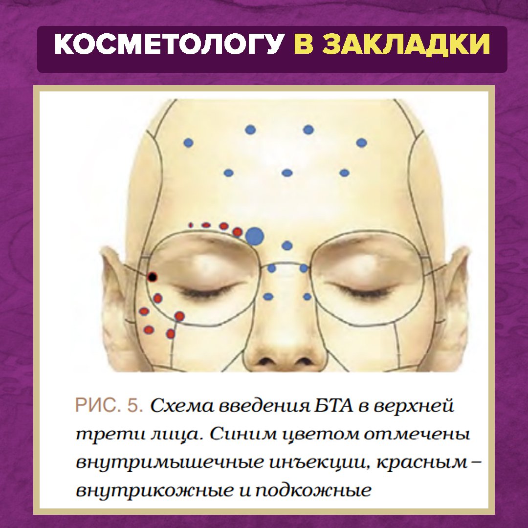 Мезоботокс схема разведения и введения